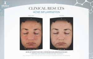 HUIDstudio27 Acne-Clinical-Results-Visia 